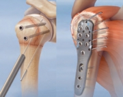 Технология навигации процесса остеосинтеза (Technology of navigating the process of osteosynthesis)